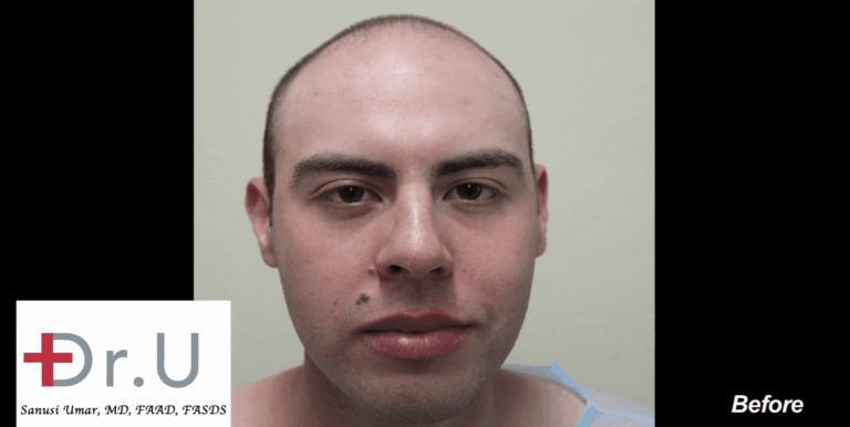 This patient began balding at a very young age. He came to Dr. Umar to help maintain his youthful appearance.