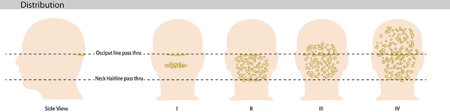 As AKN progresses, it can cover different areas and leave bumps on the back of the head and neck, and bumps on scalp.*