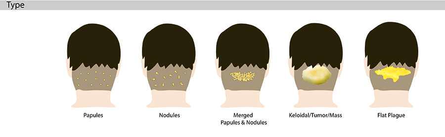 The bumps on the back of the head and neck that appear with acne keloidalis nuchae AKN can take one of these four shapes or forms.*