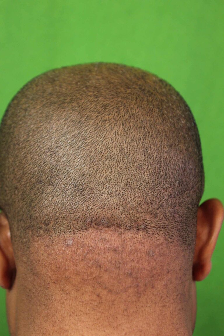 With Dr. U and ND:YAG lasers, there is a cure for the persistent bump on the back of your head and neck.*