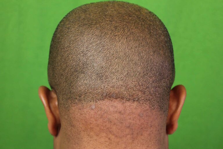 Post painful bump on back of head laser treatment with Dr U