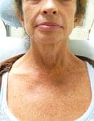 sun damaged and wrinkle treatment