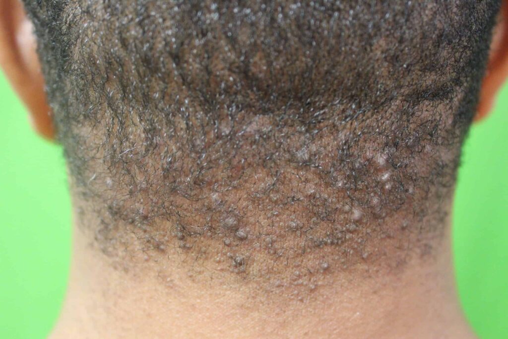 Pre-treatment with painful bumps on back of head laser cure