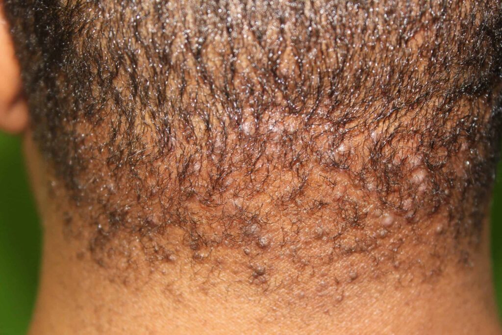 Patient before undergoing bumps on back of head laser treatment for AKN or acne keloidalis nuchae laser treatment