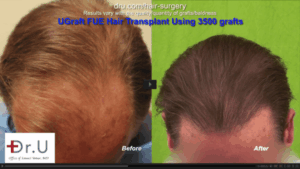 UGraft FUE Hair Transplant - 3500 grafts conservative coverage: Before and After Photos*
