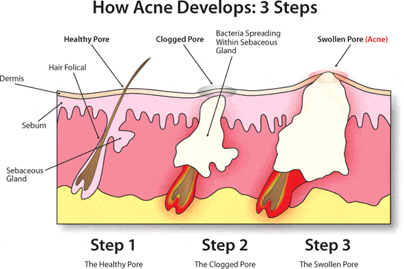 Acne Treatment Acne treatment can easily remove a zit like this.
