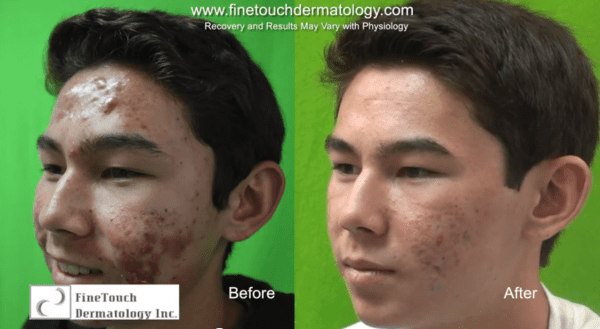 A Dr U patient before and after photodynamic treatment using lasers and levulan