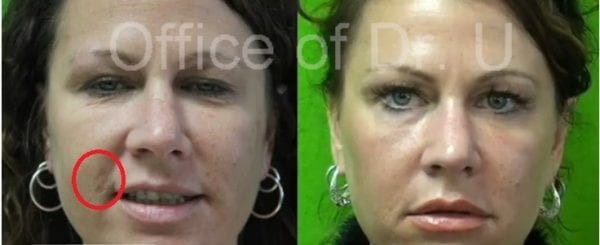 before and after treatment for age spots