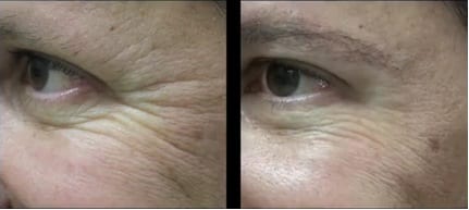 Dermal Fillers for Crows Feet Belotero reducing crows feet