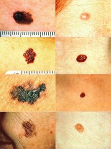 Types of Moles A variety of moles