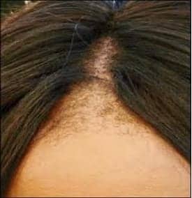 Hair loss can occur in anyone, regardless of ancestry. Fortunately, the DrUGraft can treat ethnic hair loss