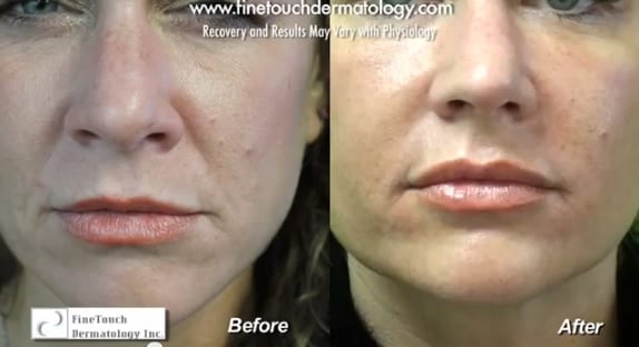 Before and after Radiesse facial filler treatment of laugh lines