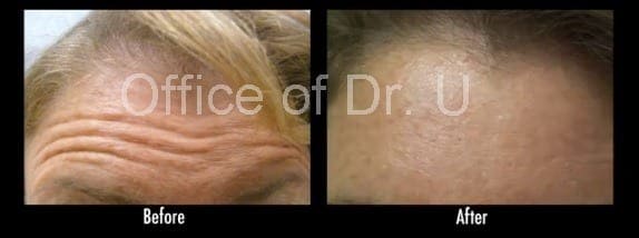 Botox wrinkle treatment