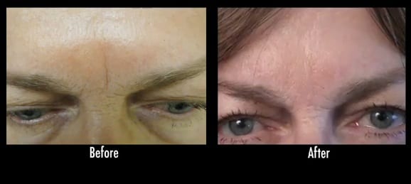 Results of Radiesse treatment for frown lines