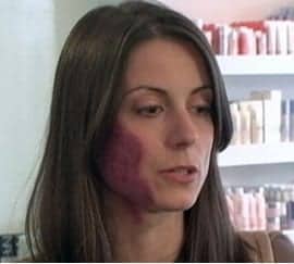 birthmark birthmark in an unwanted place