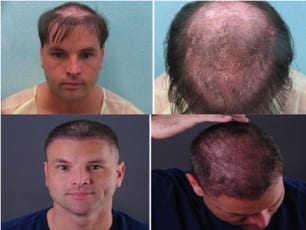 Before and after Dr.UGraft hair replacement system