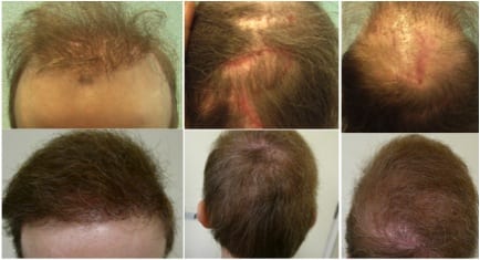 Before and after: The DrUGraft hair restoration system restored the patient's hair