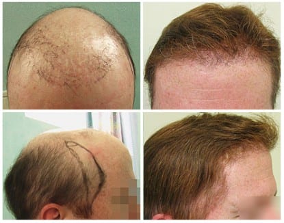Using wigs after a hair transplant: The patient underwent a hair transplant to augment his hairpiece