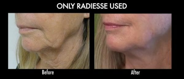 Non surgical jowl lift with Radiesse.