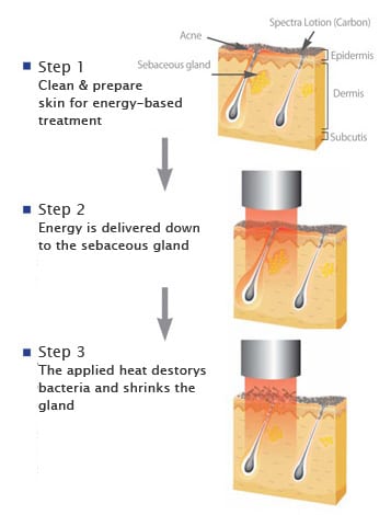 How Spectra laser treatment clears up active acne: Spectra levels out acne bumps by targeting sebaceous glands.* How Spectra laser treatment clears up active acne: Spectra levels out acne bumps by targeting sebaceous glands.*