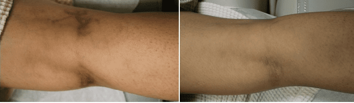 How to remove veins in legs: Dr. U generally recommends using the scelro therapy or laser treatment. Here is a leg vein removal before and after.