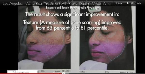 Came for an acne scar treatment and showed improvement as evident by the Visia complaxion analysis results