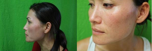 Age spots on her face