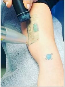 When tattoo removal gained popularity through celebrity endorsement, it inspired many people to ask "How much is tattoo removal?" When tattoo removal gained popularity through celebrity endorsement, it inspired many people to ask "How much is tattoo removal?"