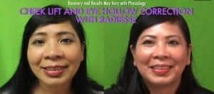 Radiesse is one of the best filler injections in cheeks Radiesse is one of the best filler injections in cheeks