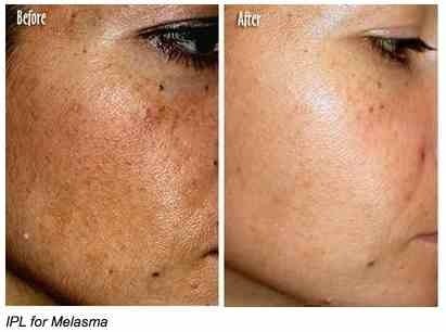 When considering melasma treatment options, laser treatment is highly effective.