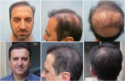 Hair replacement surgery: Before and after transformation by Dr.UGraft