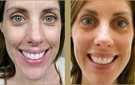 Patients dermal fillers before and after photo