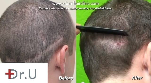 With the help of Dr. Umar's advanced FUE by Dr.UGraft method, this only shows full coverage and no visible scarring.
