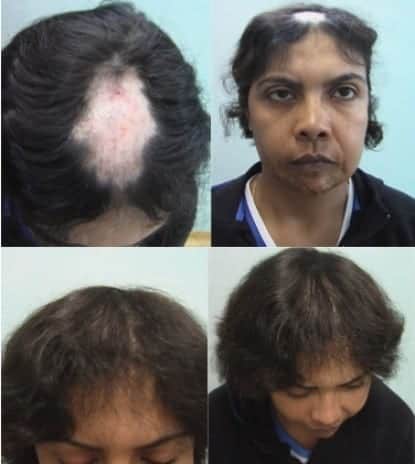 Female baldness can results from a number of conditions, including genetics, hormones, or damage to hair follicles Female baldness can results from a number of conditions, including genetics, hormones, or damage to hair follicles
