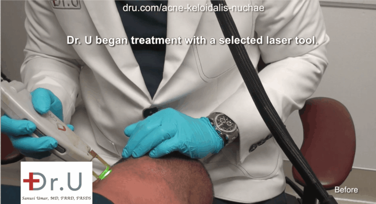 Dr. U uses the ND:YAG laser during this patient's AKN laser treatment. According to Dr.U's classification of AKN variations, laser treatment works best when the bumps are small and isolated (papules).