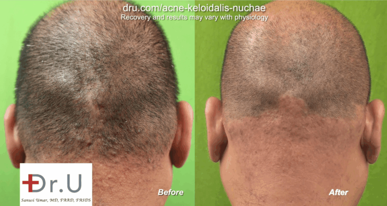 This patient saw the painful bumps on the back of his head disappear after five AKN laser treatments.