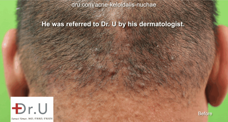 Before his acne keloidalis nuchae treatment with laser at the Dr. U AKN Clinic in Los Angeles, this patient suffered from AKN for a decade. 