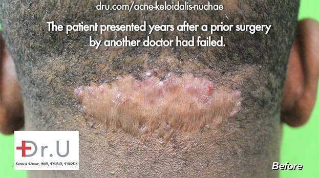 AKN surgery and scar revision 