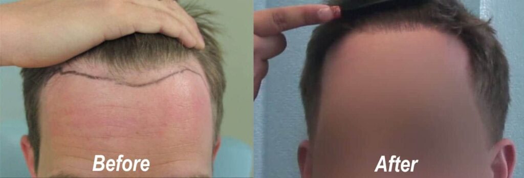 Receding hairline hair transplant before and after 1850 grafts