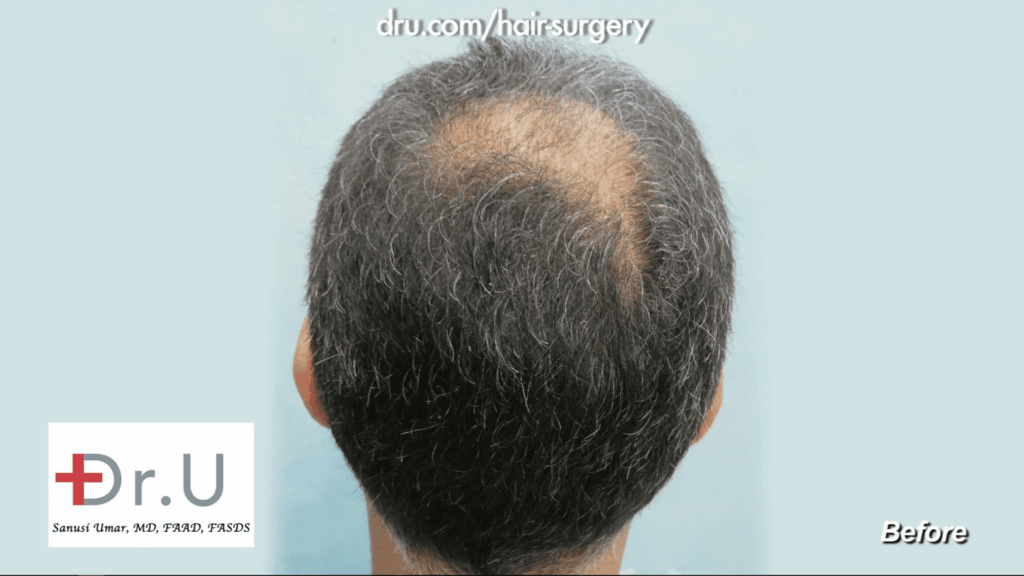 This patient experienced balding on the crown of his head, which was very visible from behind.