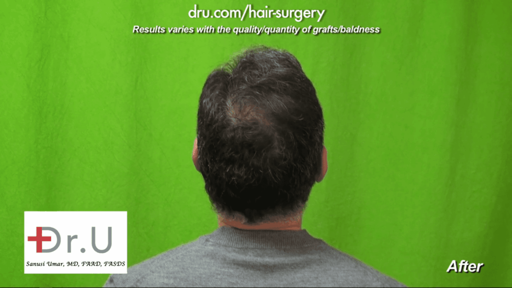 The patient's previous crown baldness isn't visible following Crown Baldness Restoration using Dr.UGraft FUE. Dr. Umar used 1200 DrUGrafts to treat the patient.