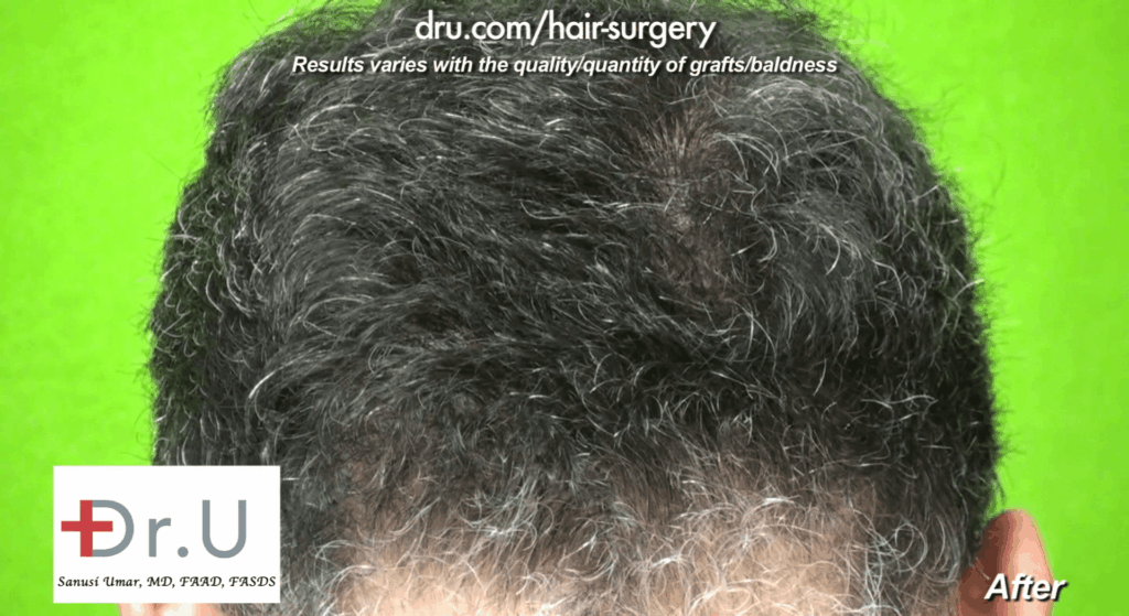 The Dr.UGraft leaves no cosmetically significant scarring, just a rich head of hair behind!