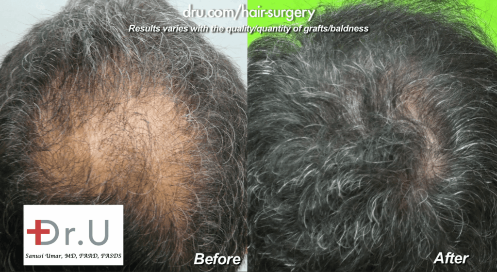 Dr. Umar extracted 1200 DrUGrafts from other areas of the scalp for this patient's crown baldness restoration with DrUGraft FUE.