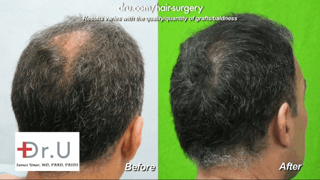 Crown baldness restoration: before and after photos