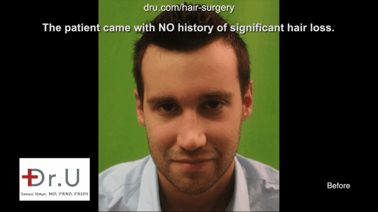 Dr.UGraft FUE Forehead Reduction by Hairline Using 3200 Grafts - Before Dr.UGraft FUE Forehead Reduction by Hairline Using 3200 Grafts - Before