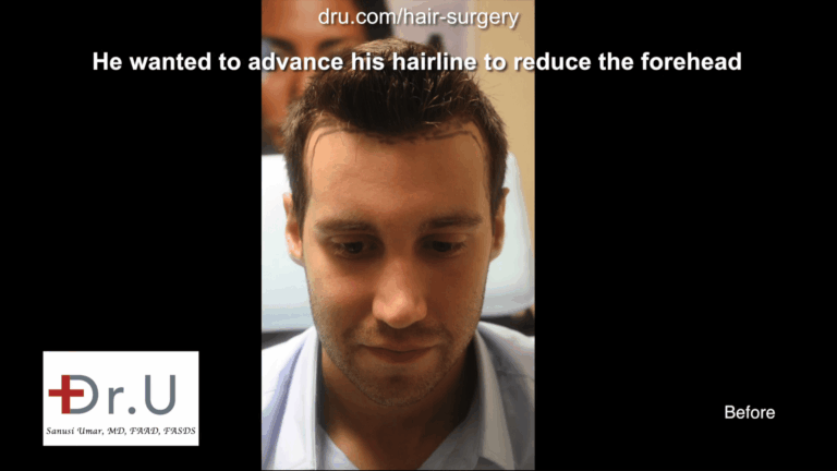 The patient wanted his hairline to cover more of the forehead and stronger temple points to match his new hairline. The patient wanted his hairline to cover more of the forehead and stronger temple points to match his new hairline.