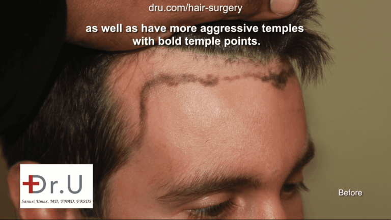 Hairline temple closure - Forehead reduction hairline transplantation Hairline temple closure - Forehead reduction hairline transplantation
