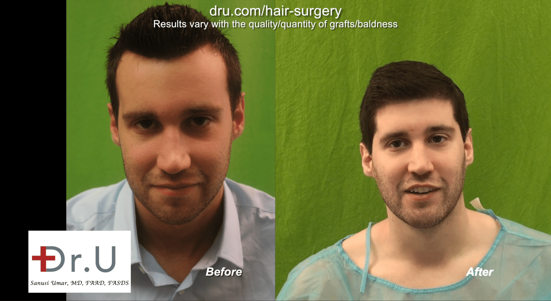 Before and After - Hairline Reduction Surgery using Dr.UGraft Method.
