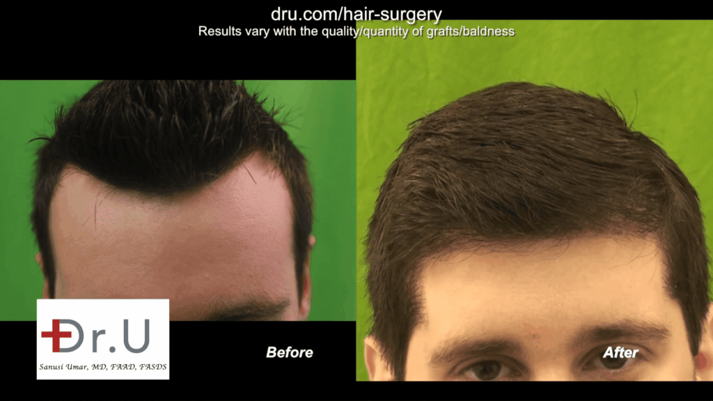 Improved natural hairline with the DrUGraft method at the best hair transplant clinic in the world A patient's hairline appears more natural after undergoing the DrUGraft procedure at the best hair transplant clinic in the world