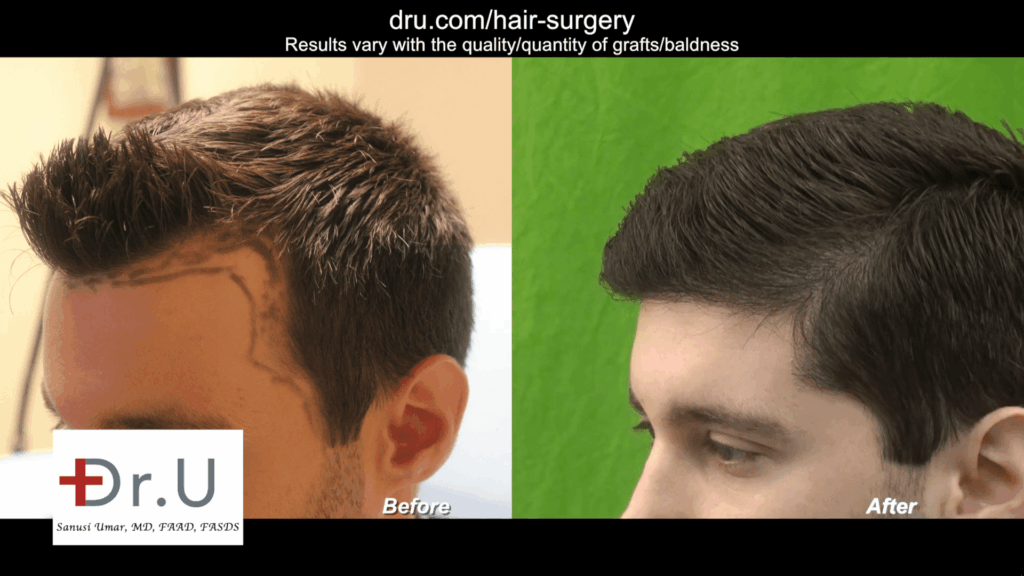 A well executed hair restoration as shown in this Dr UGraft advanced FUE patient is priceless.